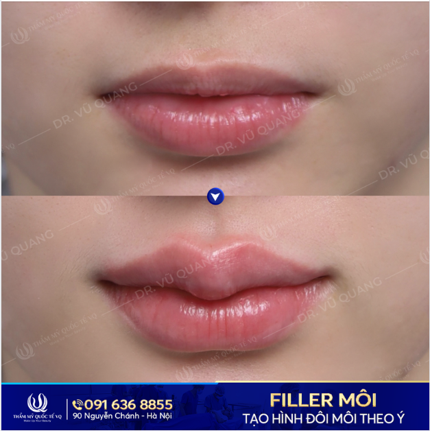 NHẮC NHẸ CHỊ EM