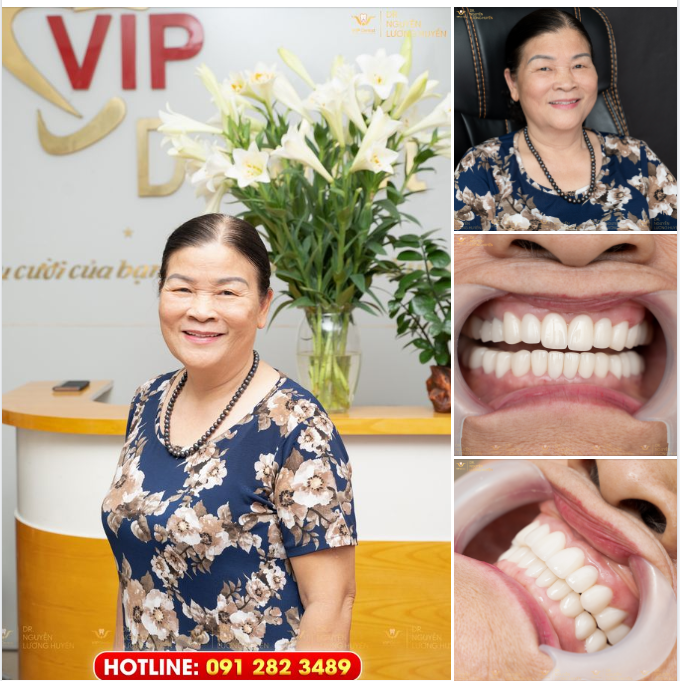 NHẤT KHỎE NHÌ ĐẸP - KHI RĂNG SỨ THẨM MỸ KHÔNG CHỈ ĐƠN GIẢN LÀ THẨM MỸ