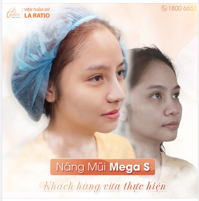 NHẸ NHÀNG THAY ĐỔI DÁNG MŨI - ĐƯA NHAN SẮC LÊN NGÔI