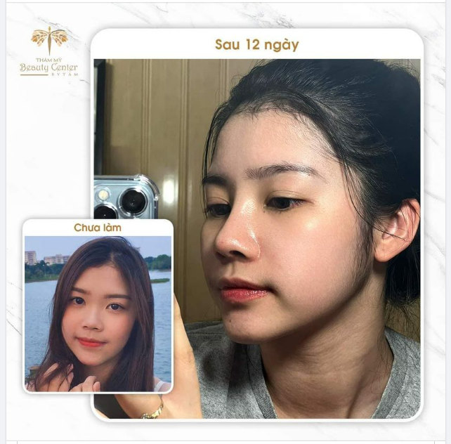 Nhìn kết quả mũi 12 ngày tuổi thế này có ai thổn thức không