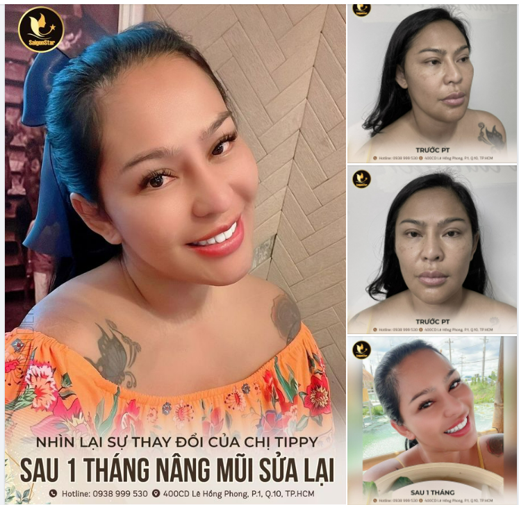 NHÌN LẠI SỰ THAY ĐỔI CỦA CHỊ TIPPY SAU 1 THÁNG NÂNG MŨI SỬA LẠI