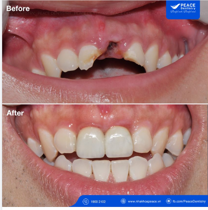 Nhổ chân răng,  Cấy Implant tức thì R21 và R11