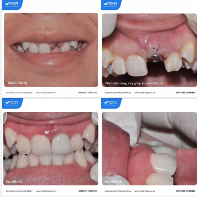 Nhổ răng chân răng và  cấy ghép implant tức thì