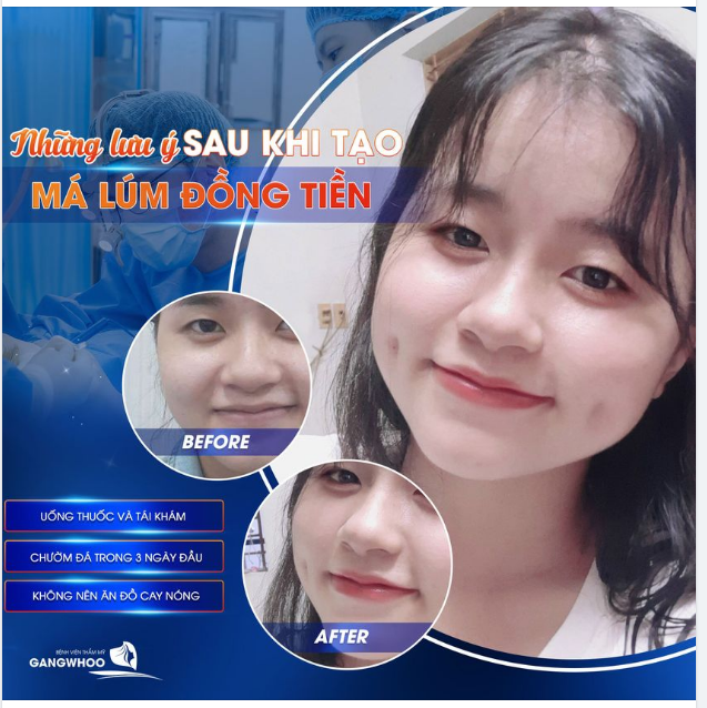 NHỮNG LƯU Ý SAU TẠO MÁ LÚM ĐỒNG TIỀN ĐỂ NHANH HỒI PHỤC VÀ BỀN LÂU