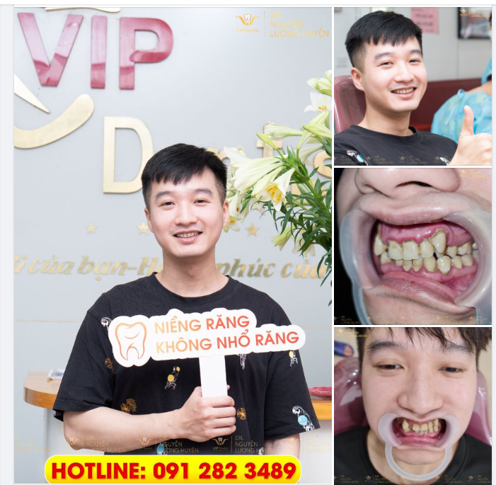 NIỀM VUI NGÀY TÁI KHÁM ĐỊNH KỲ - KHẮC PHỤC TRIỆT ĐỂ RĂNG KHẤP KHỂNH, CUNG HÀM VỀ FORM NHƯ Ý
