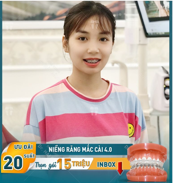 NIỀNG RĂNG AN TÂM CHẤT LƯỢNG XỨNG TẦM