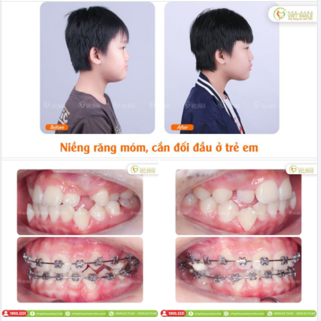 NIỀNG RĂNG CẢI THIỆN MÓM, KHỚP CẮN ĐỐI ĐẦU Ở TRẺ