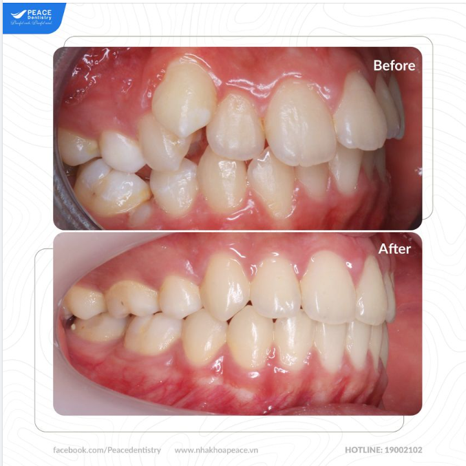 NIỀNG RĂNG CHEN CHÚC (LỆCH LẠC)