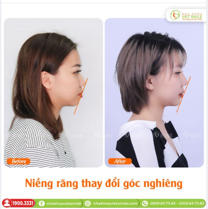 NIỀNG RĂNG CHO GÓC NGHIÊNG ĐẸP HƠN?