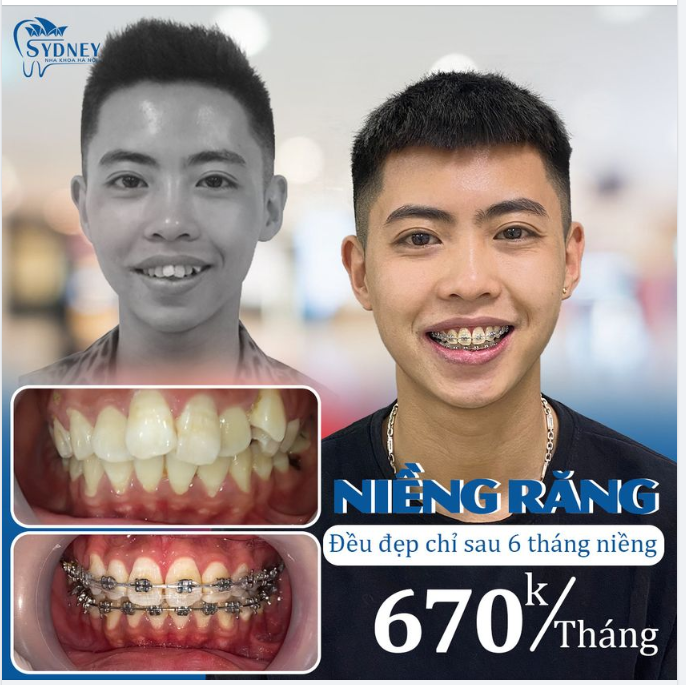 NIỀNG RĂNG CÓ ĐẸP TRAI HƠN KHÔNG 