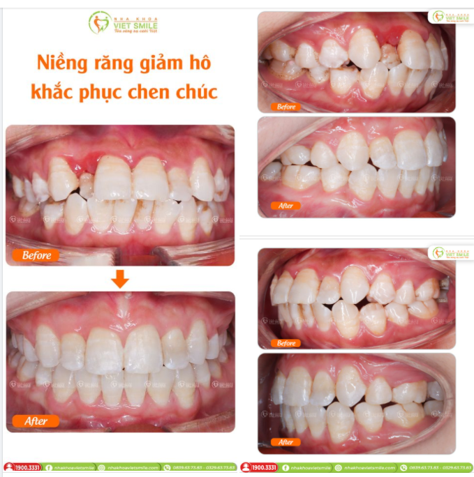 NIỀNG RĂNG GIẢM HÔ, KHẮC PHỤC TÌNH TRẠNG CHEN CHÚC NẶNG