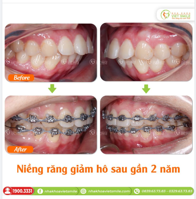 NIỀNG RĂNG GIẢM HÔ SAU GẦN 2 NĂM