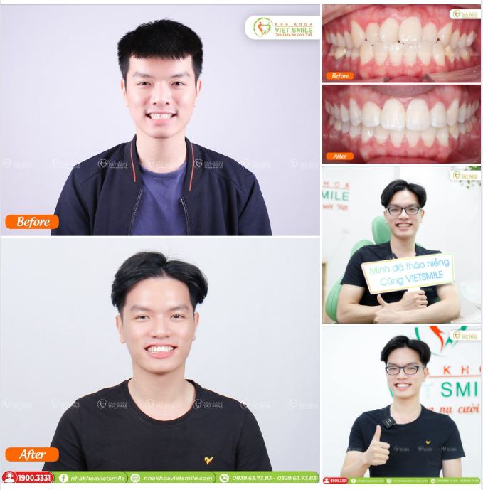 NIỀNG RĂNG HẾT CHEN CHÚC SAU 1,5 NĂM