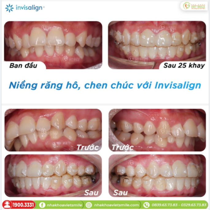 NIỀNG RĂNG HÔ, CHEN CHÚC SAU 25 KHAY INVISALIGN