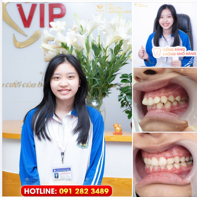NIỀNG RĂNG HÔ KHÔNG AI BIẾT - ĐẸP LÊN TỪNG NGÀY CHẲNG AI HAY