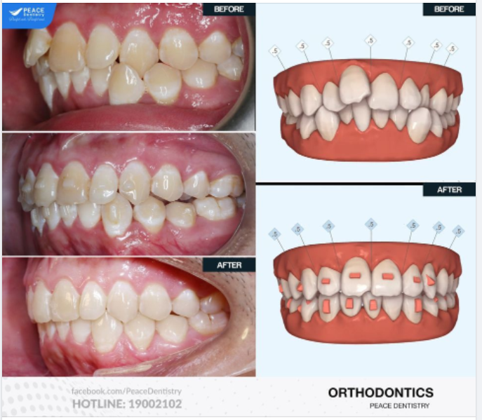Niềng răng Invisalign cho khách hàng nam 20 tuổi