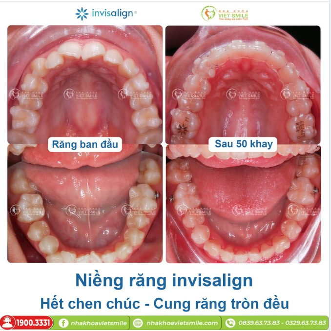 NIỀNG RĂNG INVISALIGN - HẾT CHEN CHÚC, CUNG RĂNG TRÒN ĐỀU