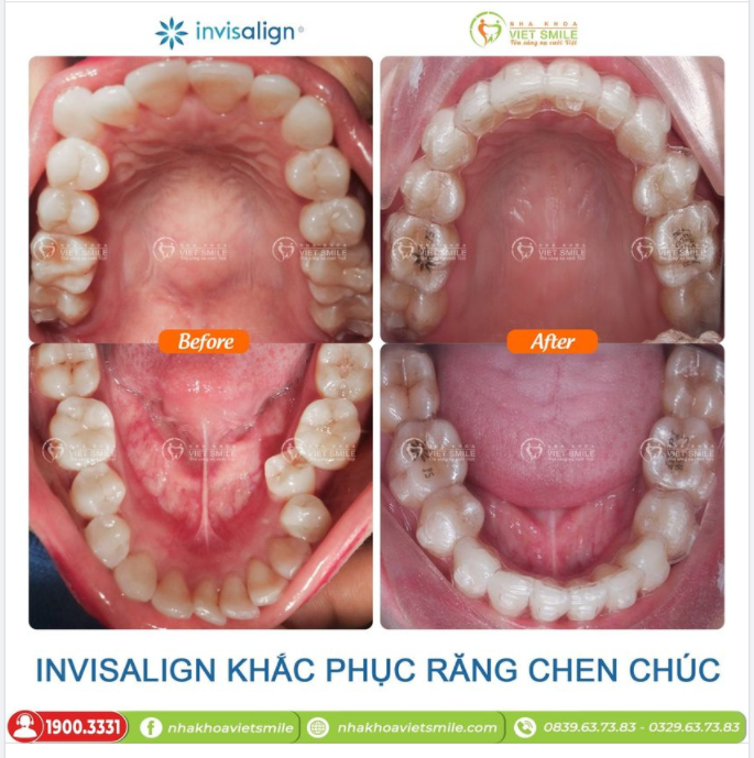 NIỀNG RĂNG INVISALIGN KHẮC PHỤC CHEN CHÚC