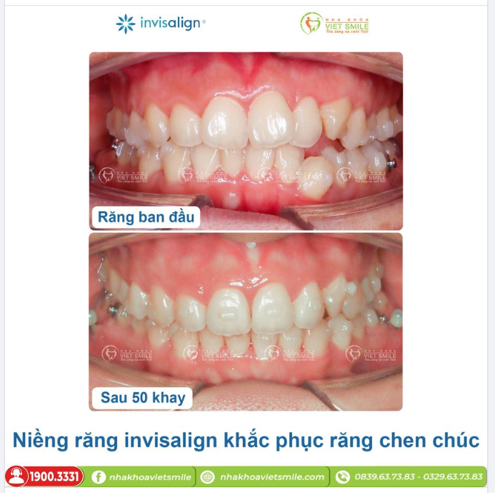 NIỀNG RĂNG INVISALIGN KHẮC PHỤC RĂNG CHEN CHÚC