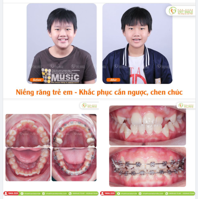 NIỀNG RĂNG KHẮC PHỤC RĂNG MÓM - KHỚP CẮN NGƯỢC Ở TRẺ EM