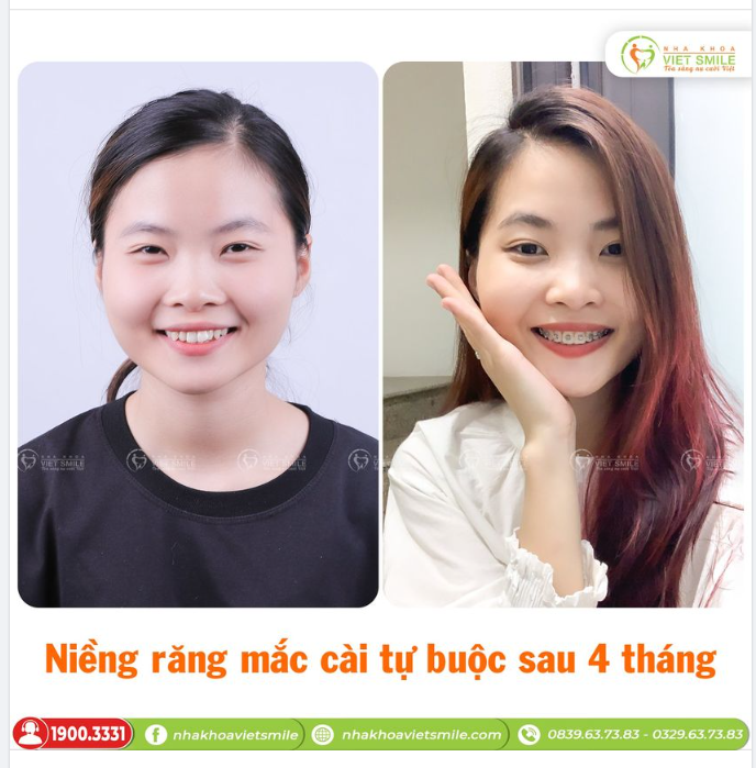 NIỀNG RĂNG KHẤP KHỂNH VỚI MẮC CÀI TỰ BUỘC SAU 4 THÁNG CÓ GÌ THAY ĐỔI?