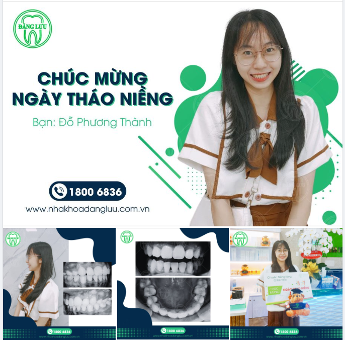 NIỀNG RĂNG - Không chỉ là vẻ đẹp, mà còn là sức khỏe!