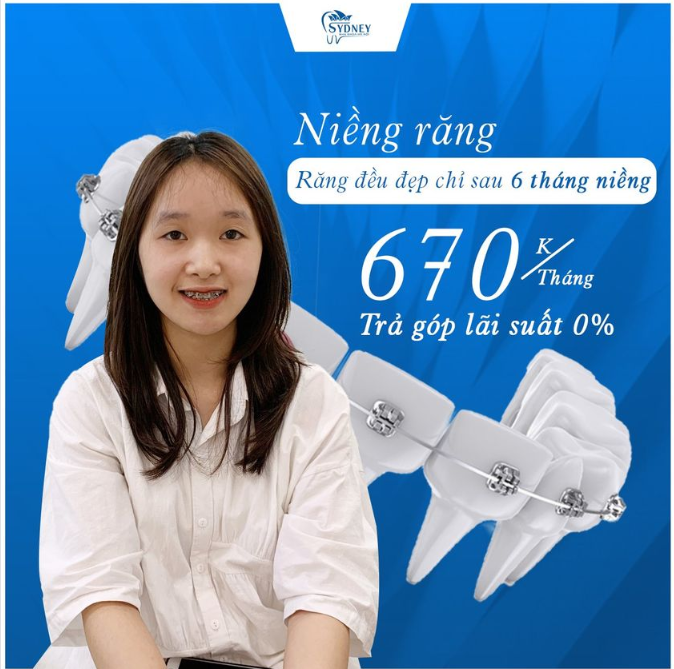 NIỀNG RĂNG KIM LOẠI TRUYỀN THỐNG SIÊU TIẾT KIỆM