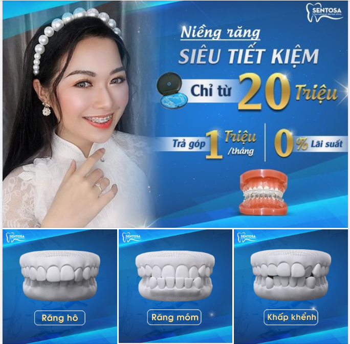 NIỀNG RĂNG MẮC CÀI CHỈ TỪ 20 TRIỆU - RÚT NGẮN 6 THÁNG