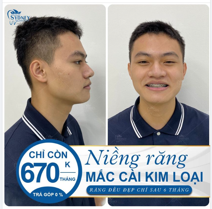 NIỀNG RĂNG MẮC CÀI KIM LOẠI PHÙ HỢP VỚI NHỮNG TÌNH TRẠNG NÀO