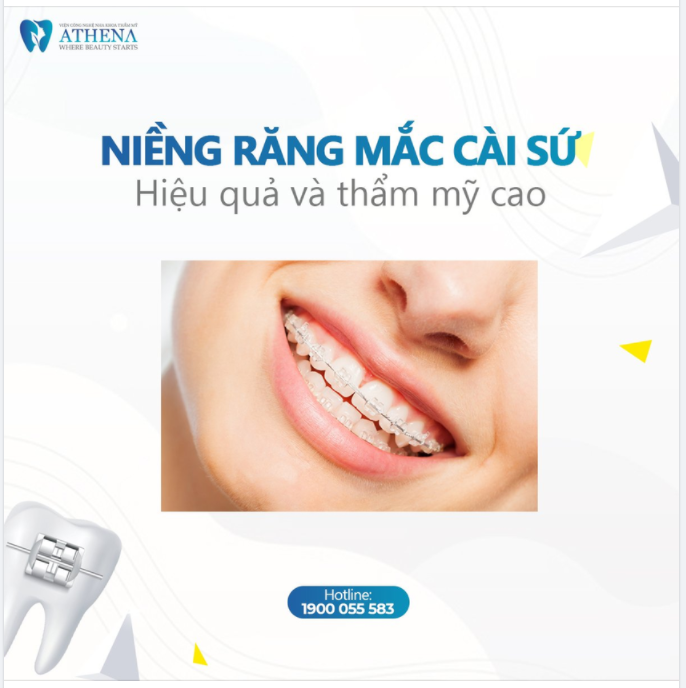 NIỀNG RĂNG MẮC CÀI SỨ - HIỆU QUẢ VÀ THẨM MỸ CAO 
