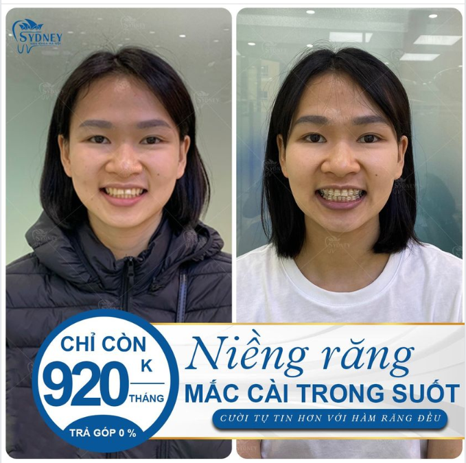 NIỀNG RĂNG PHA LÊ CHỈ TỪ 920K/THÁNG