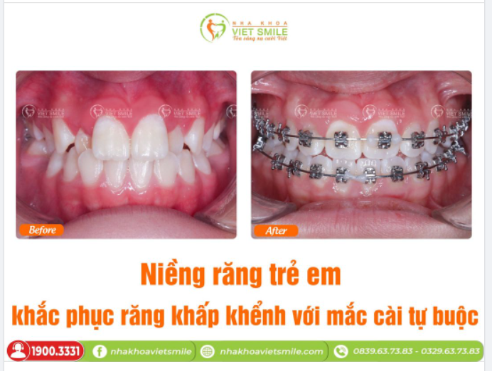 NIỀNG RĂNG TRẺ EM - KHẮC PHỤC KHẤP KHỂNH VỚI MẮC CÀI TỰ BUỘC