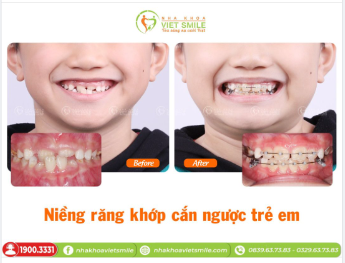 NIỀNG RĂNG TRẺ EM - KHẮC PHỤC KHỚP CẮN NGƯỢC