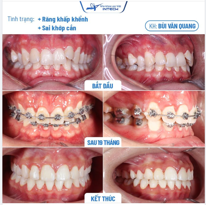 NIỀNG RĂNG X-MATRIX - KHẮC PHỤC RĂNG LỆCH LẠC, SAI KHỚP CẮN