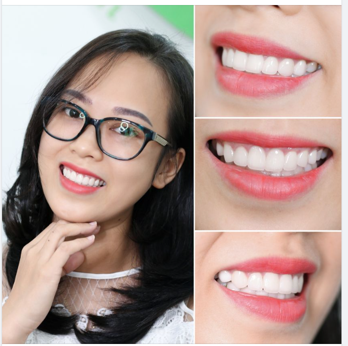 NỤ CƯỜI ẤN TƯỢNG CỦA KHÁCH HÀNG DÁN SỨ VENEER ULTRATHIN