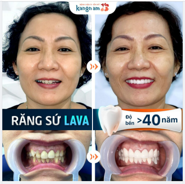 Nụ cười của chị khách thay đổi ngoạn mục sau khi bọc răng sứ LAVA
