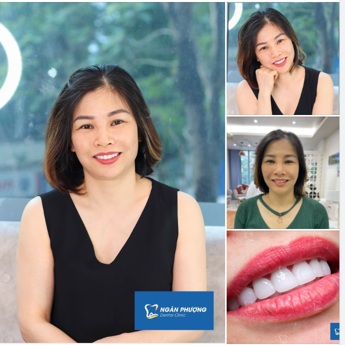 Nụ cười không tuổi, nghệ thuật giữ mãi nét xuân cho nụ cười với răng sứ thẩm mỹ