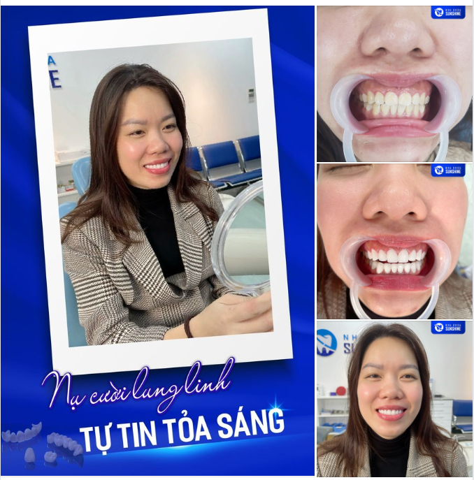 NỤ CƯỜI LUNG LINH – TỰ TIN TOẢ SÁNG