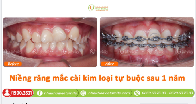NỤ CƯỜI THÊM XINH SAU 1 NĂM NIỀNG RĂNG TẠI VIET SMILE