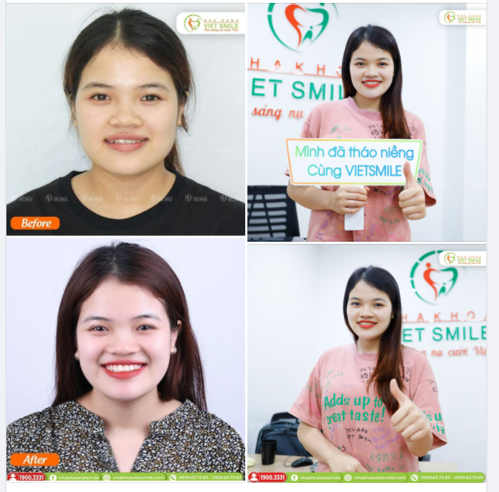 NỤ CƯỜI TỰ TIN, RẠNG RỠ SAU 6 THÁNG THÁO NIỀNG RĂNG MÓM