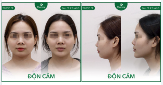 Phải xem những trường hợp như ảnh bên dưới thì mới thấy được tác dụng thay đổi diện mạo đỉnh cao của phẫu thuật độn cằm đúng không cả nhà