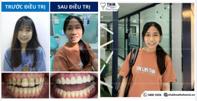 Phục Hình Răng Sứ Tại Nha Khoa Thế Hệ Mới