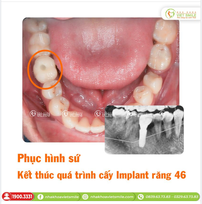 PHỤC HÌNH SỨ - KẾT THÚC QUÁ TRÌNH CẤY IMPLANT RĂNG 46