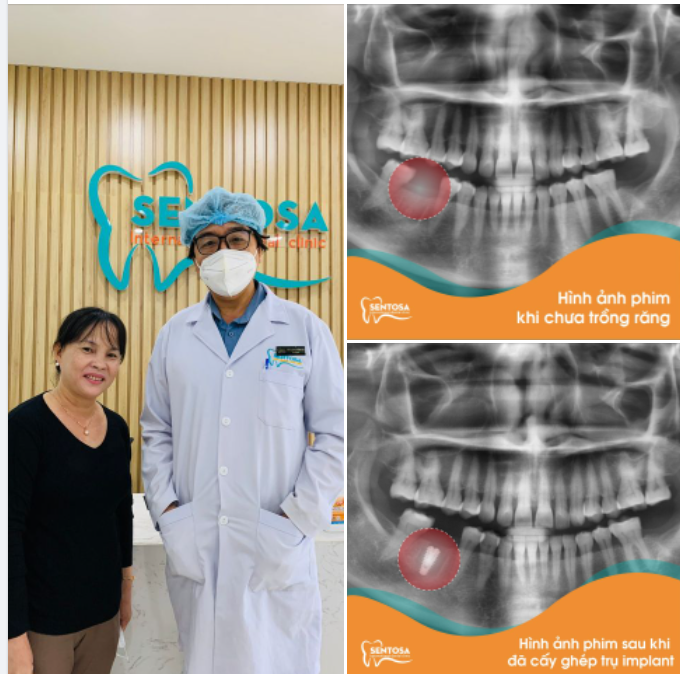 PHỤC HỒI RĂNG MẤT BẰNG PHƯƠNG PHÁP CẤY GHÉP IMPLANT