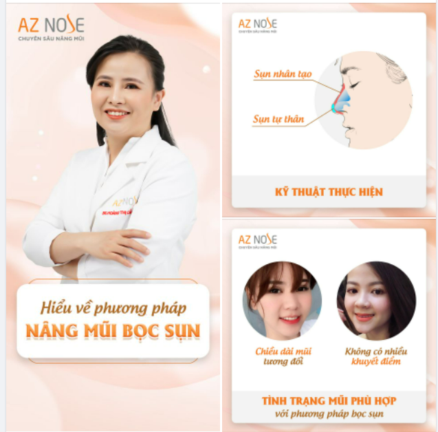 Phương pháp nâng mũi bọc sụn và những lưu ý quan trọng