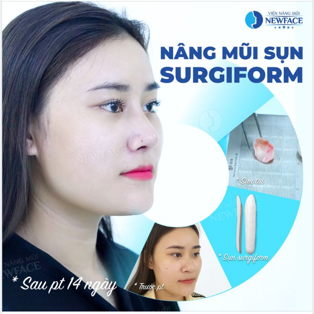 PHƯƠNG PHÁP NÀO “NHẸ NHÀNG” NHẤT TRONG LÀM MŨI