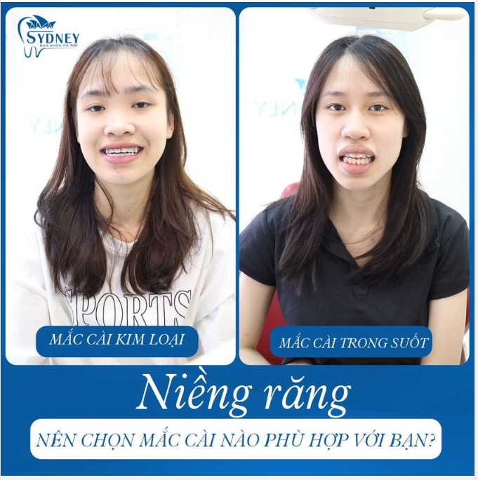 PHƯƠNG PHÁP NIỀNG RĂNG NÀO PHÙ HỢP VỚI BẠN: PHA LÊ HAY KIM LOẠI