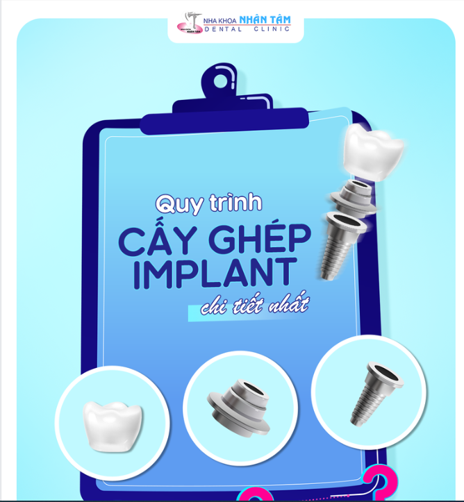 QUY TRÌNH CẤY GHÉP IMPLANT CHI TIẾT NHẤT