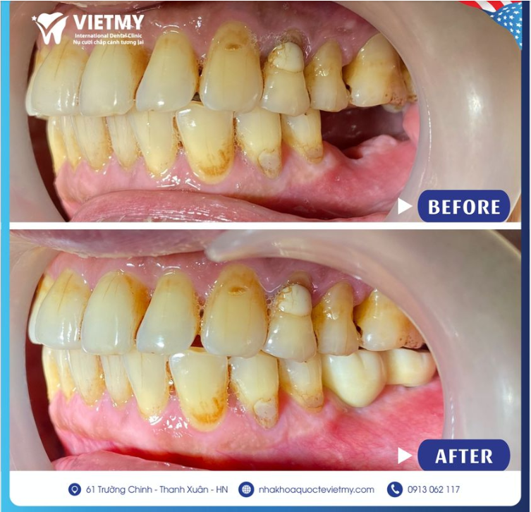 RĂNG CŨ MẤT LÂU NĂM- MỌC NGAY RĂNG MỚI NHỜ NHA KHOA QUỐC TẾ VIỆT MỸ