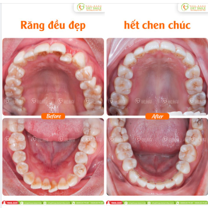RĂNG ĐỀU ĐẸP - HẾT CHEN CHÚC SAU THÁO NIỀNG